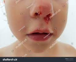 Broken Nose Blood Child Stock Photo Edit Now 1476660245