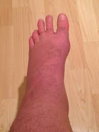 Depending on the cause of peeling. Week 9 Tuesday Moisturising The Dead Skin Away Surgical Repair Of My Left Ankle