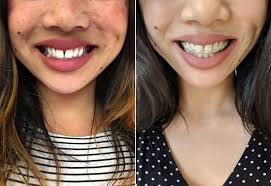 In a clinical sense, the need for braces is to fix a health issue and those people who do need braces should not wait to get them. Should I Get Adult Braces Popsugar Beauty