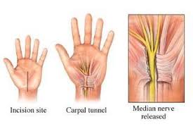 Rubber Band Hand Exercises Carpal Tunnel Carpal Tunnel Surgery Carpal Tunnel Exercises