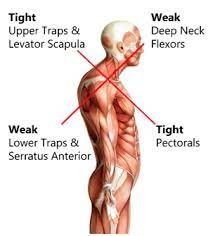 Upper Cross Syndrome Nw Chiropractic And Massage