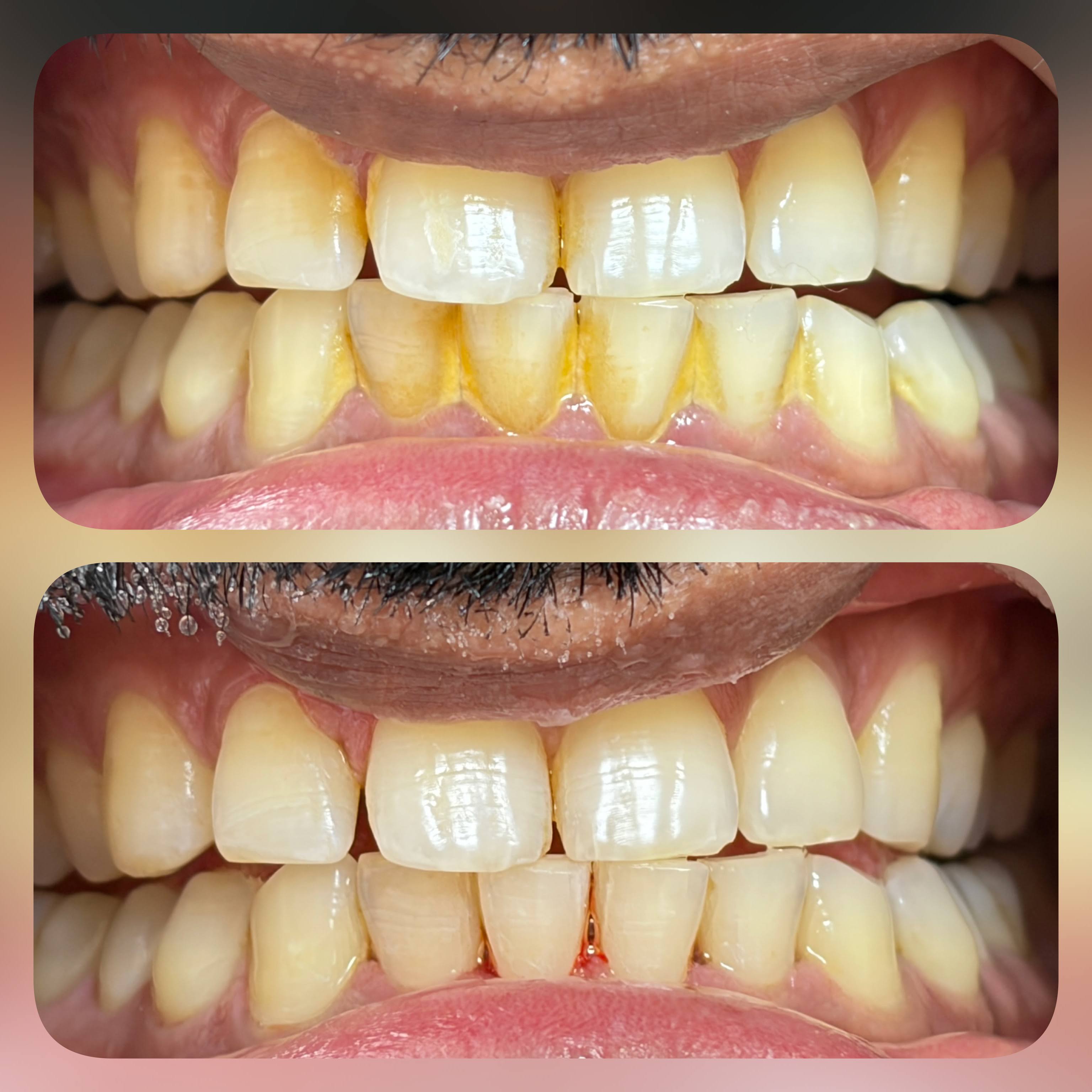 Teeth Cleaning product image