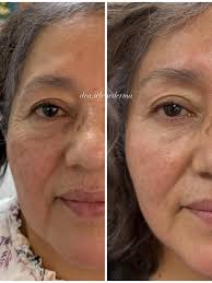 Qué alimentos influyen en el acné? Entérate con esta investigación