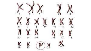 ¿qué es el síndrome de down? Sindrome De Down Sintomas Causas Y Como Tratar La Enfermedad