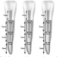 A post is cemented into a prepared root canal, which retains a core restoration, which retains the final crown. Pdf Influence Of Glass Fibre Post Cementation Depth On Dental Root Fracture Semantic Scholar