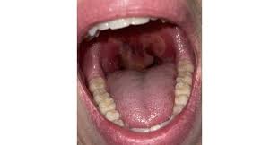 Image result for Uvulitis