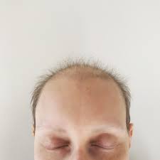 This varies from person to person. Please Stop Complimenting My Post Chemotherapy Hair Allure