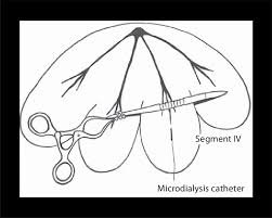 Shingles, also known as zoster or herpes zoster, is a viral disease characterized by a painful skin rash with blisters in a localized area. Diagram Of Pig Liver With A Microdialysis Catheter Placed In Segment Iv Download Scientific Diagram