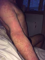 This presents as set of symptoms, most notably such severe reactions are apparently rare and there has never been a fatality in the uk from a false widow spider bite. Woman Warns About Seriousness Of False Widow Spider Bites Berkshire Live