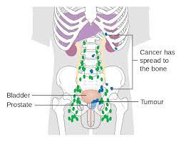 Once the cancer has reached the bones, the goal of treatment is to slow or prevent the spread of the cancer, and to control. File Diagram Showing Prostate Cancer That Has Spread To The Bones Cruk 183 Svg Wikimedia Commons