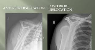 Shoulder Dislocation Anterior Posterior Y View Scapular Xr Xray Shoulder Dislocation Radiology Imaging Dislocation