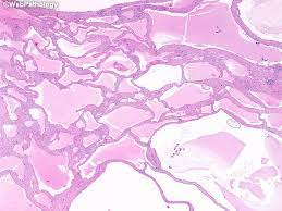Maybe you would like to learn more about one of these? Webpathology Com A Collection Of Surgical Pathology Images