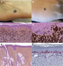 Image result for Blue Nevus