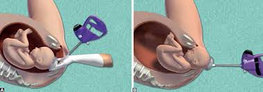 Image result for Vacuum Caput