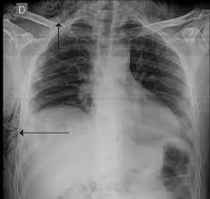 Image result for Emphysema