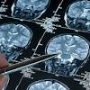 This can interfere with electrical signals and result in a seizure. 1