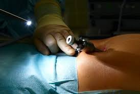 May 01, 2020 · a laparoscopic inguinal hernia repair is a routine surgery to repair a weakness or perforation in the muscle or tissue in the abdominal cavity. Hernia Mesh Surgery Using Surgical Mesh For Hernia Repairs