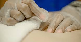 Afterward, you will be given juice and/or water to replenish the fluid donated and refresh you. Does Dry Needling Hurt Athletico