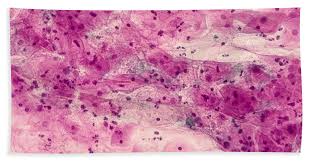 Image result for trichomonas images