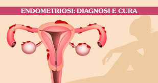 Endometriosis is the abnormal growth of endometrial cells outside the uterus. Diagnosi E Cura Dell Endometriosi Seno Clinic