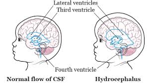 About Your Programmable Vp Shunt For Pediatric Patients Memorial Sloan Kettering Cancer Center