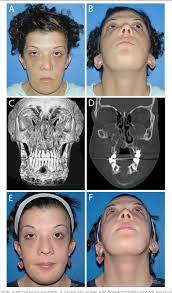 Tomography in a 41 years old woman of china origin diagnosed with cherubism shows a remarkable expansion of the mandible, which can. Figure 3 From Cherubism Best Clinical Practice Semantic Scholar