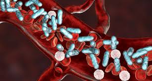 Evaluation and management of suspected sepsis and septic shock in adults. Suche Nach Massgeschneiderten Immuntherapien Bei Sepsis