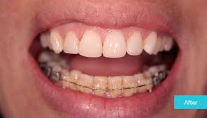 How to fix a crossbite in adults. Crossbite Problems Causes Treatment Museum Dental Suites