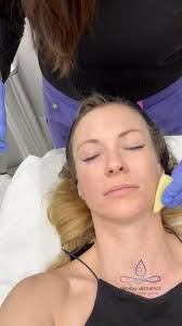 Take a look at how my ZO 3 step peel results turned out🤩, ZO 3 step peel  is a potent peel of trichloroacetic, salicylic, and lactic acids that is  suitable for all skin types. It includes a powerful ...