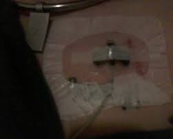 My Port With The Huber Needle In And Lumen Attached The Pink Vertical Line Is The Scar From Having The Port Placed 6 We Healthy Tips Lyme Autoimmune Disease