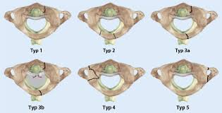 Možná jste ve svých biologických třídách narazili na pojmy atlas a obratle os. Behandlung Der Atlas Und Dens Axis Frakturen Springerlink