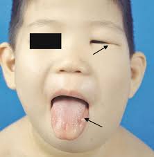 Treatment of Lymphatic Malformations