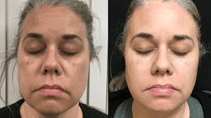 Laser Skin Rejuvenation