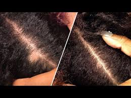 The most obvious signs of balding are, well, bald spots. Bald Spots Shedding Fast Growth Solution Natural Hair Update Curls Triple Threat Youtube