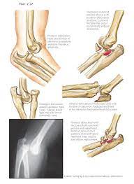 Dislocation Of Elbow Joint Dislocations Of The Elbow Joint Are The Most Common Dislocations After Those Of The Sh Dislocation Medical Knowledge Elbow Anatomy