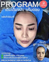 Filler งานผิว Dorothy Dewey 3 cc + pico laser + วิตตามินผิว 5,000 เฉพาะ  6-7-8 เท่านั้น 📍สาขา กทม เท่านั้น