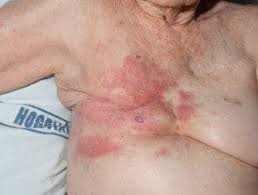 Image result for Erysipeloid