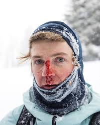 You know me—I have bad luck with tree branches. I was jumping through this  window in the trees and went a little higher than I expected. I thought my  face would just