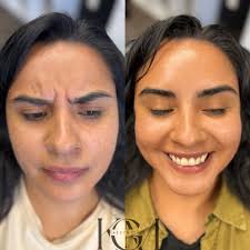 Aesthetic Injector Services and Botox Offer in Midlothian