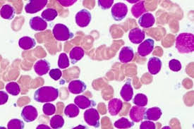 Leucemia linfoblástica aguda (lla) é um cancro da linha linfoide das células sanguíneas caracterizado pelo desenvolvimento de elevado número de linfócitos imaturos (linfoblastos). Nuevos Biomarcadores Pueden Ser De Utilidad Clinica Para La Leucemia Linfoblastica Aguda Infantil Jano Es Elsevier