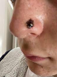 Woke Up And Skin Around Piercing Has Turned Black I Ve Had This Piercing For 4 Months Now Had A Bump And Bit Of Crust For The Last 2 Months So Have Been