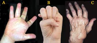 Are people with arthritis more likely to develop complications from the flu? Rheumatoid Arthritis Palm Reading Perspectives