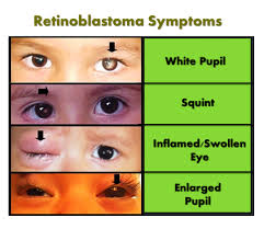 A white color in the center circle of the eye (pupil) when light is shone in the eye, such as when someone takes a flash photograph of the child eyes that appear to be looking in different directions Pin On Nursing Rn