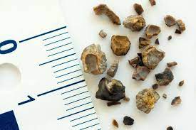We did not find results for: Kenali Beragam Gejala Batu Ginjal Pada Wanita Alodokter