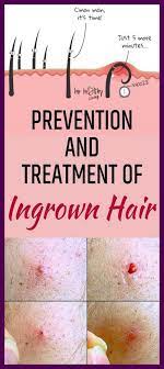 Ingrown hairs tend to be more common in areas with coarse hairs. Pin On Hair Remedies