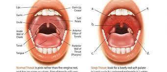 10 Best Home Remedies For Strep Throat Cure Without Antibiotics