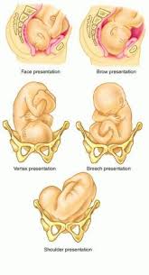 Vertex Presentation Newborn Nursing Midwifery Nursing School