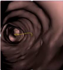 Image result for Virtual Endoscopy
