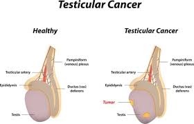 Testicular cancer, also called testis cancer, is typically treated with surgery, chemotherapy and sometimes radiation therapy. How To Check For Testicular Cancer Healthguidance Org