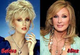 Morgan used these fillers to maintain a youthful face throughout her late thirties and forties. Morgan Fairchild Plastic Surgery A Beautiful Soap Opera Queen
